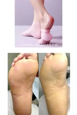 CANSU ODABAS CO Difüze Çorabı Kuru Çatlak Ayaklar İçin Krem Nüfuz Artırıcı